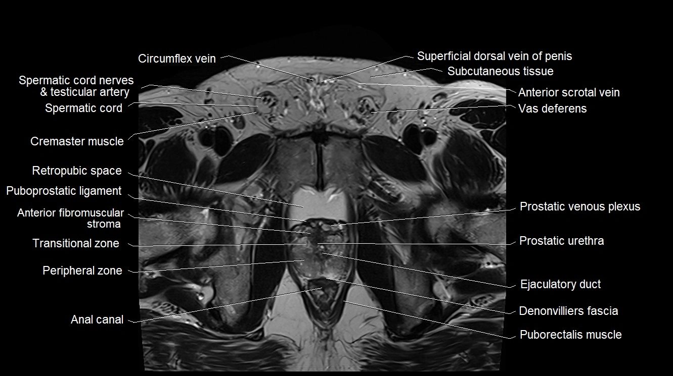 MRI 3T scrotum and penis axial cross sectional anatomy image 10.webp